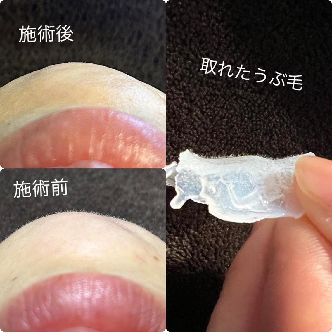 フェイスワックス脱毛｜古い角質と産毛を取り除きます。施術の前後と、実際に取れた産毛の写真です。